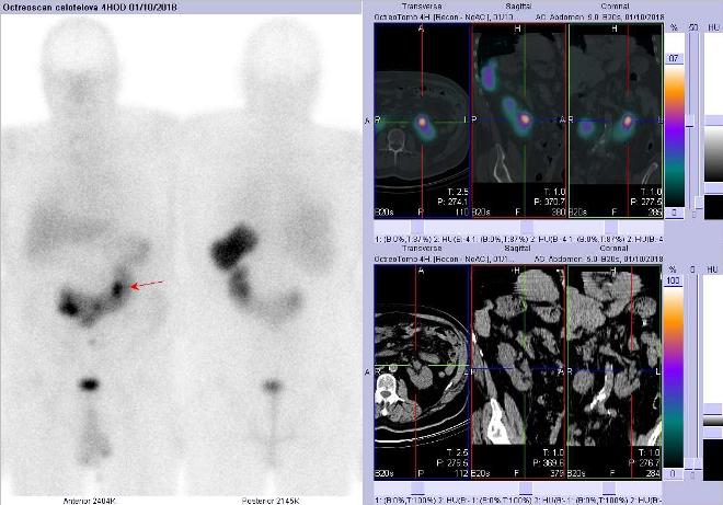 Obr. . 2: Celotlov scintigrafie vpedn a zadn projekci a fze obraz SPECT a CT. Vyeten 4 hod. po aplikaci radioindiktoru. Vpravo zameno na loisko vdutm systmu lev sti podkovovit ledviny.