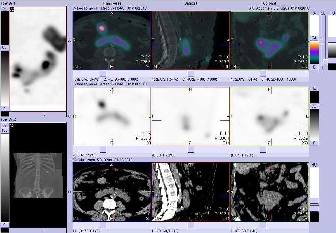 Obr. . 3: Fze obraz SPECT a CT. Vyeten 4 hod. po aplikaci radioindiktoru. Zameno na podkovovitou ledvinu.