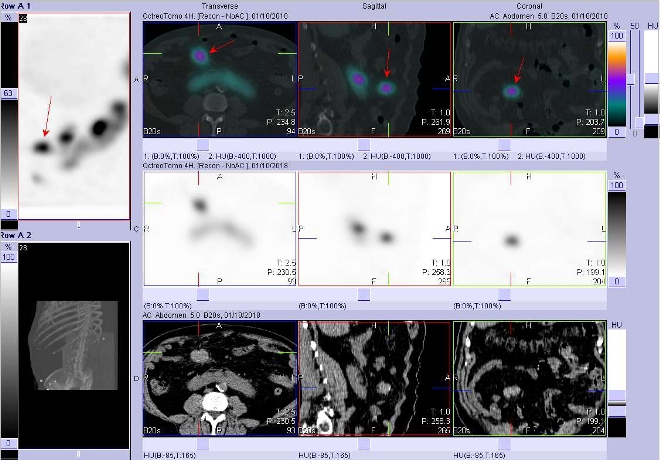 Obr. . 4: Fze obraz SPECT a CT. Vyeten 4 hod. po aplikaci radioindiktoru. Zameno na loisko v pravm mezogastriu.