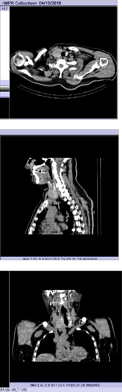 Obr. . 8: CT krku. Vyeten 24 hod. po aplikaci radioindiktoru. Patrn nodozn struma suzlem vpravm laloku ttn lzy.