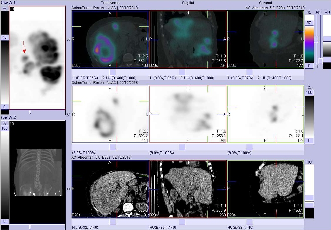 Obr. . 7: Fze obraz SPECT a CT. Vyeten 24 hod. po aplikaci radioindiktoru. Zameno na loisko v mediln sti pravho jaternho laloku.