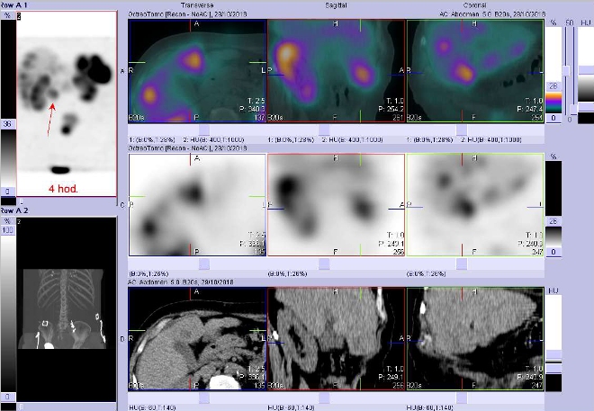 Obr. . 2: Fze obraz SPECT a CT. Zameno na jatern loisko. Vyeten 4 hod. po aplikaci OctreoScanu.