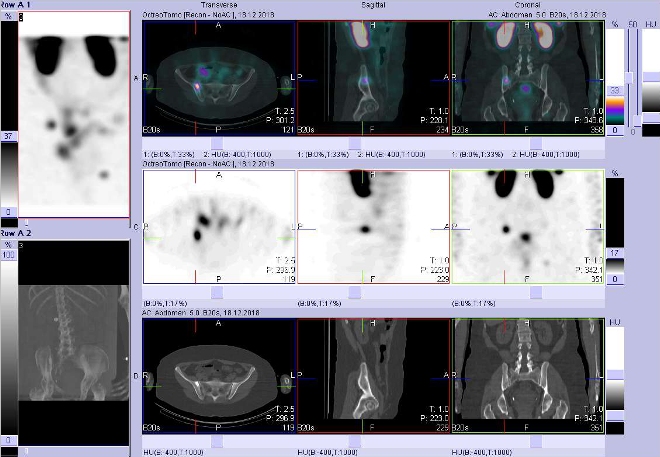 Obr. . 7: Fze obraz SPECT a CT.  Zameno na loisko v lopat kosti kyeln vpravo. Vyeten 24 hod. po aplikaci OctreoScanu.