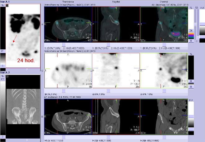 Obr. . 10: Fze obraz SPECT a CT. Vyeten 24 hod. po aplikaci radioindiktoru. Zameno na loisko v kosti kyeln vpravo.