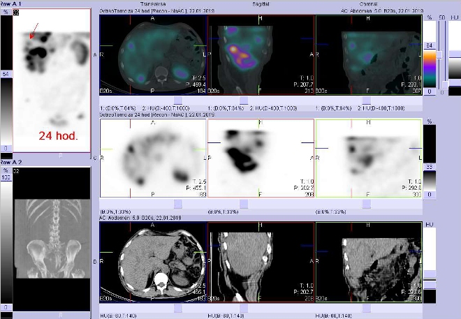 Obr. . 12: Fze obraz SPECT a CT. Vyeten 24 hod. po aplikaci radioindiktoru. Zameno na loisko vpravm jaternm laloku.