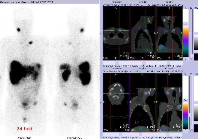 Obr.3: Celotlov scintigrafie a fze obraz SPECT a CT. Vyeten 24 hod. po aplikaci radioindiktoru. Zameno na loisko vlev kln kosti vblzkosti sternoklavikulrnho sklouben a na uzlinu vpravo na krku.