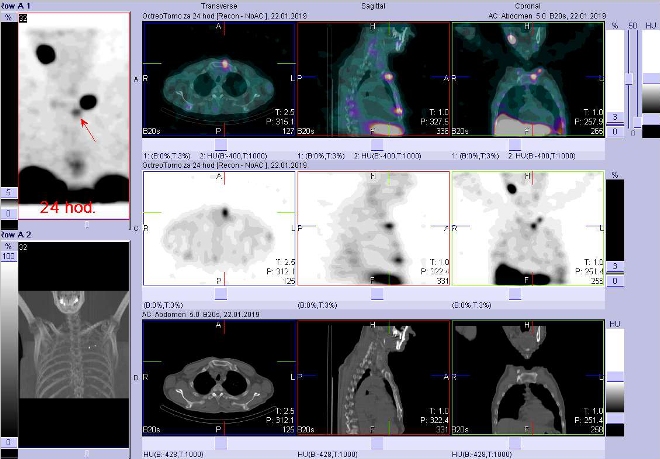 Obr. . 4: Fze obraz SPECT a CT. Vyeten 24 hod. po aplikaci radioindiktoru. Zameno na loisko v levm sternoklavikulrnm sklouben.