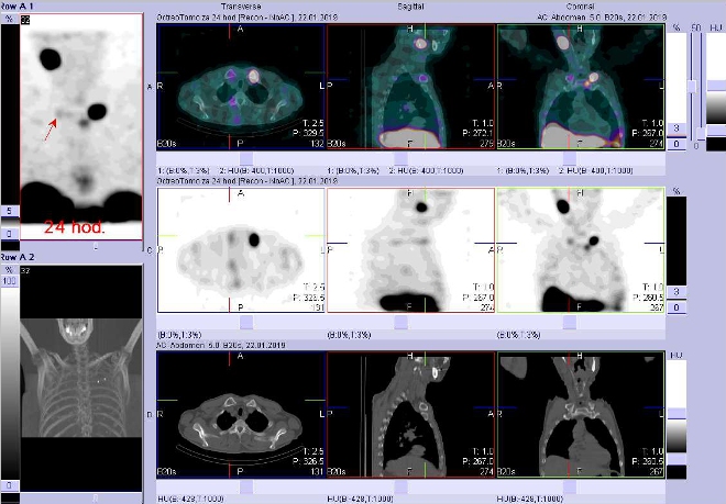 Obr. . 5: Fze obraz SPECT a CT. Vyeten 24 hod. po aplikaci radioindiktoru. Zameno na loisko vprav kln kosti vblzkosti sternoklavikulrnho sklouben.