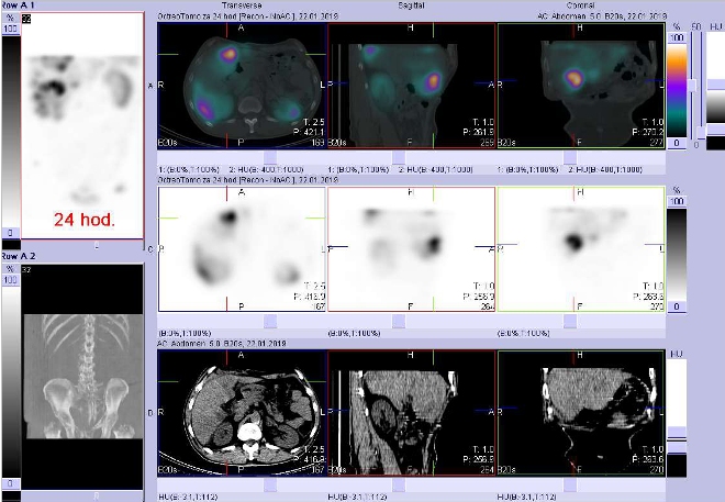 Obr. . 7: Fze obraz SPECT a CT. Vyeten 24 hod. po aplikaci radioindiktoru. Zameno na loisko vpravm jaternm laloku.