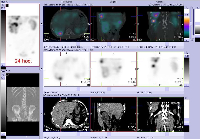 Obr. . 8: Fze obraz SPECT a CT. Vyeten 24 hod. po aplikaci radioindiktoru. Zameno na loisko vpravm jaternm laloku.