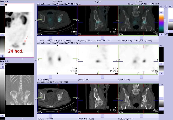 Obr. . 9: Fze obraz SPECT a CT. Vyeten 24 hod. po aplikaci radioindiktoru. Zameno na loisko v kosti kyeln vlevo nad acetabulem.
