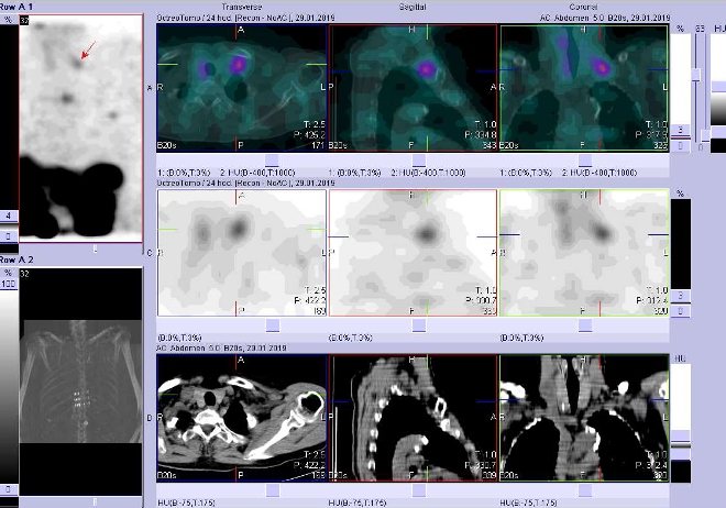 Obr. . 13: Fze obraz SPECT a CT. Zameno na uzlinu supraklavikulrn vlevo. Vyeten 24 hod. po aplikaci radioindiktoru.