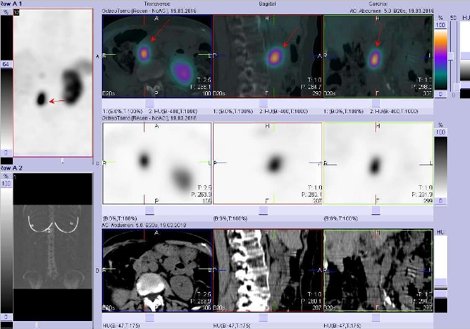 Obr.3: Fze obraz SPECT a CT. Zameno na loisko paraaortln vpravo vuzlin vrovni L2/L3. Vyeten 4 hod. po aplikaci radioindiktoru.