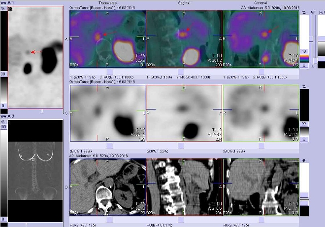 Obr. . 4: Fze obraz SPECT a CT. Zameno na loisko vuzlin paravertebrln vpravo ve vi Th12/L1. Vyeten 4 hod. po aplikaci radioindiktoru.