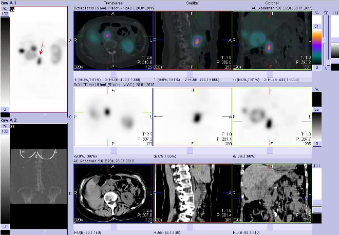 Obr. . 7: Fze obraz SPECT a CT. Zameno na loisko paraaortln vpravo vuzlin vrovni L2/L3. Vyeten 4 hod. po aplikaci radioindiktoru.