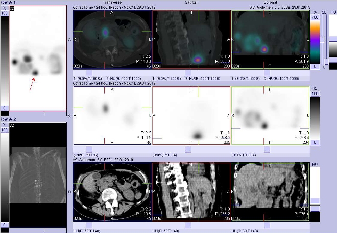 Obr. . 9: Fze obraz SPECT a CT. Zameno na loisko paraaortln vpravo vuzlin vrovni L2/L3. Vyeten 24 hod. po aplikaci radioindiktoru.