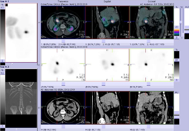 Obr. . 1: Fze obraz SPECT a CT. Vyeten 4 hod. po aplikaci radioindiktoru. Zameno na loisko mezi pankreatem a duodenem.