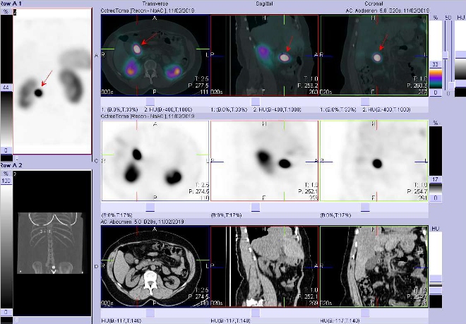 Obr. . 3: Fze obraz SPECT a CT. Vyeten 4  hod. po aplikaci radioindiktoru. Zameno na loisko mezi pankreatem a duodenem.