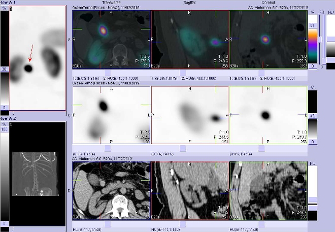 Obr. . 4: Fze obraz SPECT a CT. Vyeten 4  hod. po aplikaci radioindiktoru. Zameno na loisko mezi pankreatem a duodenem.