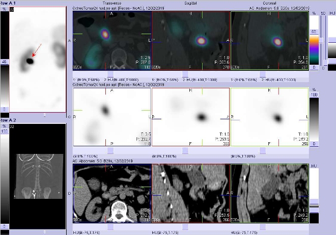 Obr. . 5: Fze obraz SPECT a CT. Vyeten 24 hod. po aplikaci radioindiktoru. Zameno na loisko mezi pankreatem a duodenem.