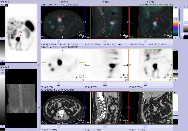 Obr. . 6: Fze obraz SPECT a CT. Vyeten 24 hod. po aplikaci radioindiktoru. Zameno na loisko v mezenteriu v rovni L3/4.