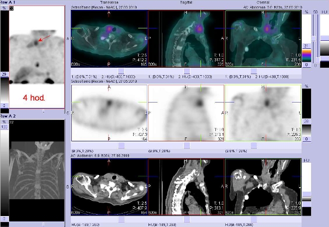 Obr. . 2: Fze SPECT/CT krku a hrudnku 4 hod. po aplikaci OctreoScanu. Zameno na loisko v pravm laloku ttn lzy.