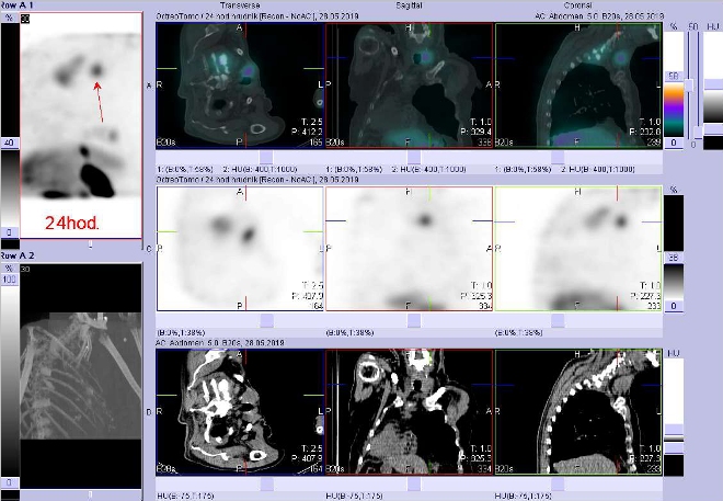 Obr. . 8: Fze SPECT/CT krku, hrudnku a proximln sti bicha 24 hod. po aplikaci OctreoScanu. Zameno na loisko vlaloku ttn lzy.