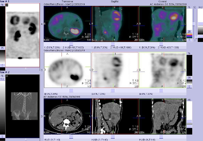 Obr. . 5: Fze obraz SPECT a CT. Vyeten 4 hod. po aplikaci radiofarmaka. Zameno na loisko s nekrzou  ve ventrokaudln sti pravho jaternho laloku.