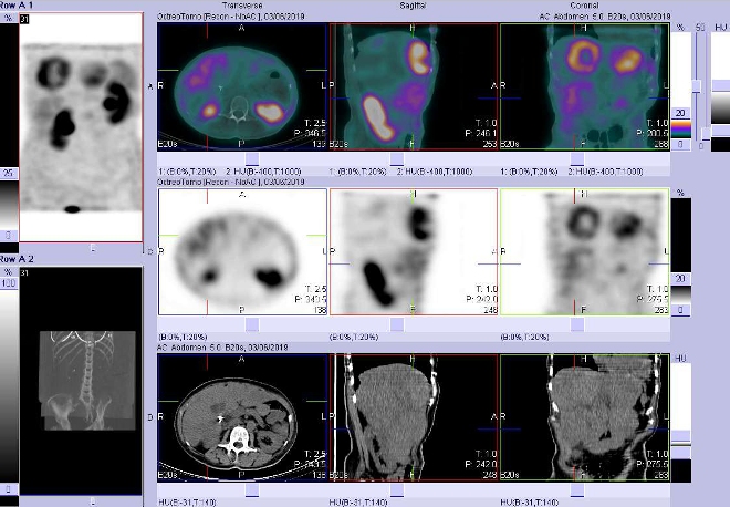 Obr. . 6: Fze obraz SPECT a CT. Vyeten 4 hod. po aplikaci radiofarmaka. Zameno na loisko s nekrzou  ve ventrokaudln sti pravho jaternho laloku.