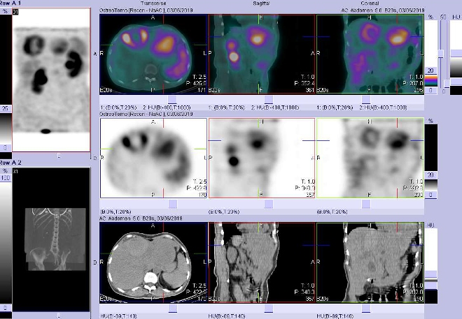 Obr. . 7: Fze obraz SPECT a CT. Vyeten 4 hod. po aplikaci radiofarmaka. Zameno na loisko s  ve ventrokraniln sti levho jaternho laloku.