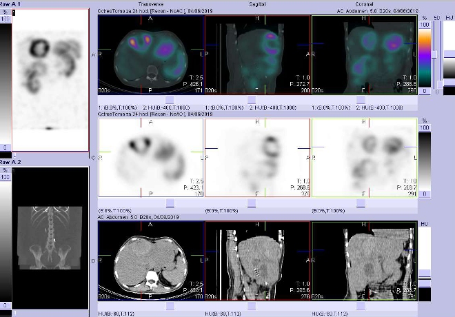 Obr. . 8: Fze obraz SPECT a CT. Vyeten 24 hod. po aplikaci radiofarmaka. Zameno na loisko s nekrzou  ve ventrokraniln sti pravho jaternho laloku.