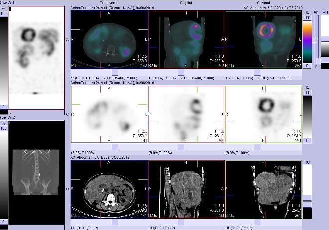 Obr. . 9: Fze obraz SPECT a CT. Vyeten 24 hod. po aplikaci radiofarmaka. Zameno na loisko s nekrzou  ve ventrokaudln sti pravho jaternho laloku.