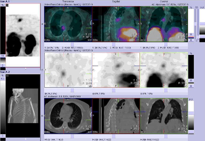 Obr. . 5: Fze SPECT/CT krku, hrudnku a proximln sti bicha 24 hod. po aplikaci OctreoScanu. Zameno na loisko v mediastinu vpravo.