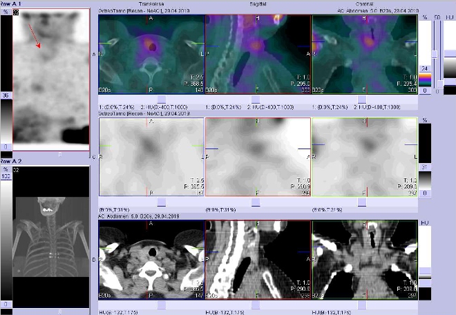 Obr. . 4: Fze obraz SPECT a CT. Zameno na loisko v pravm laloku ttn lzy. Vyeten 4 hod. po aplikaci OctreoScanu.