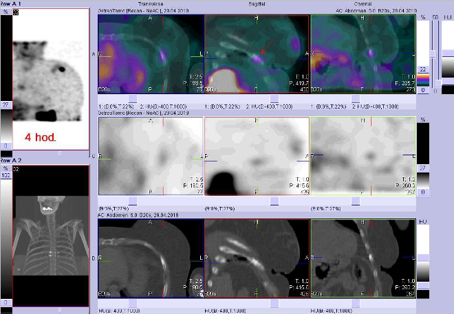 Obr. . 5: Fze obraz SPECT a CT. Zameno na loisko v jednom levostrannm ebru ventrolaterln. Vyeten 4 hod. po aplikaci OctreoScanu.