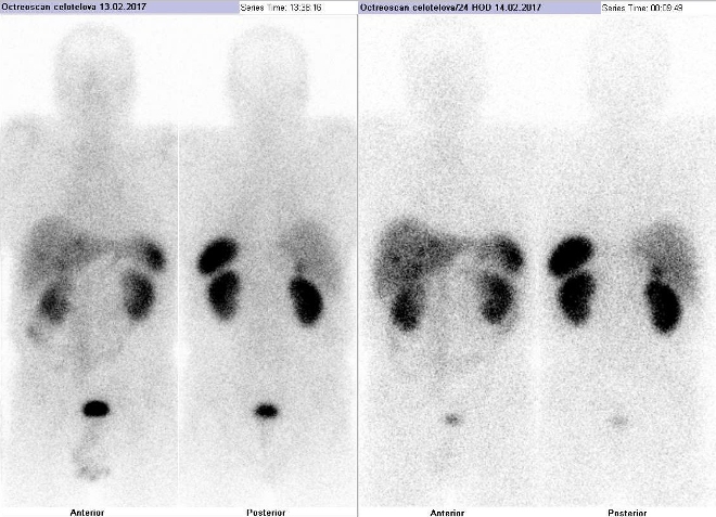 Obr. . 1: Celotlov scintigrafie vpedn a zadn projekci. Vyeten 4 hod. (vlevo) a 24 hod. (vpravo) po aplikaci radioindiktoru.