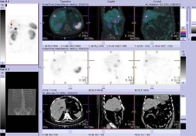 Obr. . 7: Fze obraz SPECT a CT  vyeten 24 hod. po aplikaci radiofarmaka. Zameno na loisko ve ventrolaterln stipravho jaternho laloku.