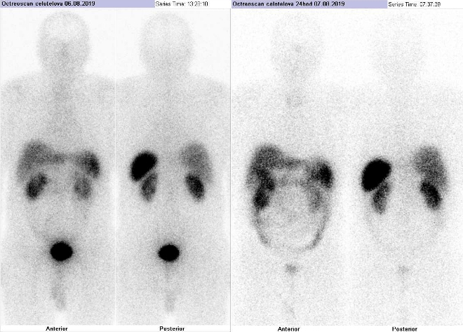 Obr..1: Celotlov scintigrafie vpedn a zadn projekci. Vyeten 4 hod. (vlevo) a 24 hod. (vpravo) po aplikaci radioindiktoru.