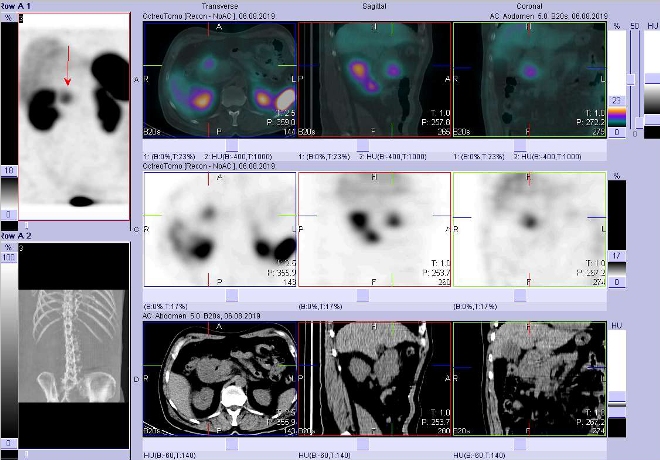 Obr. . 2: Fze obraz SPECT a CT  vyeten bicha a pnve 4 hod. po aplikaci radiofarmaka. Zameno na loisko v oblasti duodena.