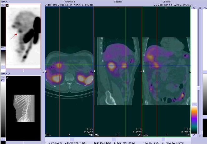 Obr. . 3: Fze obraz SPECT a CT  vyeten 24 hod. po aplikaci radiofarmaka. Zameno na loisko voblasti duodena.