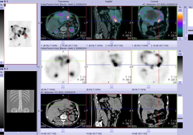Obr. . 7: Fze obraz SPECT a CT. Vyeten 4 hod. po aplikaci radioindiktoru. Zameno na loisko v levm jaternm laloku.