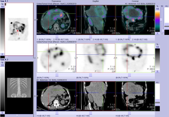 Obr. . 9: Fze obraz SPECT a CT. Vyeten 4 hod. po aplikaci radioindiktoru. Zameno na loisko v pravm jaternm laloku.