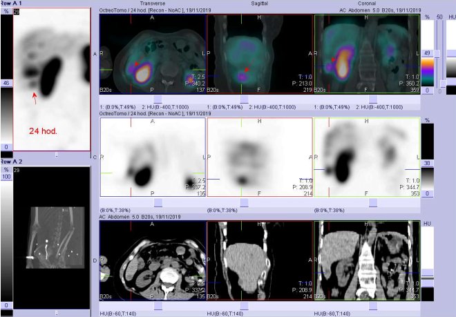 Obr. . 12: Fze obraz SPECT a CT. Vyeten 24 hod. po aplikaci radioindiktoru. Zameno na loisko vpravm jaternm laloku.