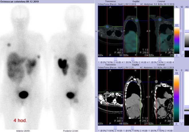 Obr.1: Celotlov scintigrafie v pedn a zadn projekci a fze SPECT/CT se zamenm na podkon loisko vpravo v horn a ventrln sti hrudnku 4 hod. po aplikaci OctreoScanu.
