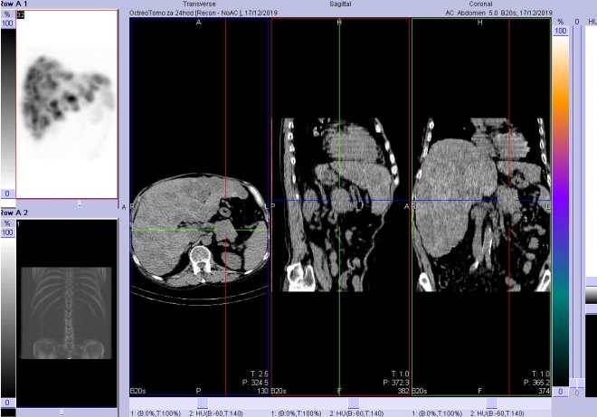 Obr.3: CT 24 hod. po aplikaci OctreoScanu. Zameno na loisko v kaud pankreatu.