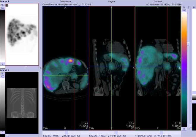 Obr. . 4: Fze SPECT/CT 24 hod. po aplikaci OctreoScanu. Zameno na loisko v kaud pankreatu.