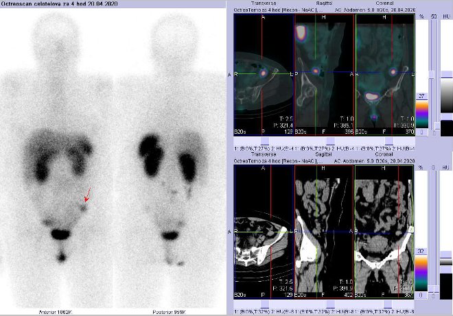 Obr..2: Celotlov scintigrafie a fze SPECT/CT bicha 4 hod. po aplikaci OctreoScanu. Zameno na loisko vpnvi vlevo laterln.