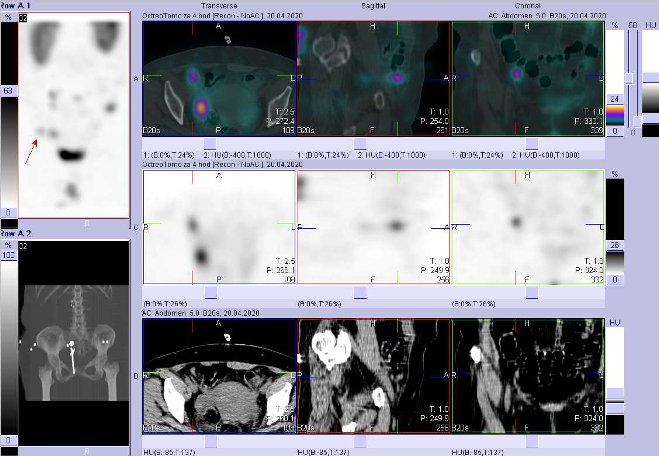 Obr.3: Fze SPECT/CT bicha a pnve 4 hod. po aplikaci OctreoScanu. Zameno na loisko v pnvi vpravo ventrln.