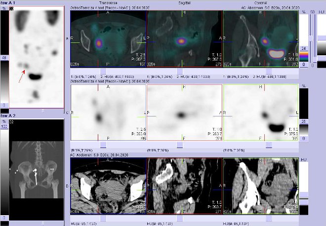 Obr. . 4: Fze SPECT/CT bicha a pnve 4 hod. po aplikaci OctreoScanu. Zameno na loisko v pnvi vpravo.