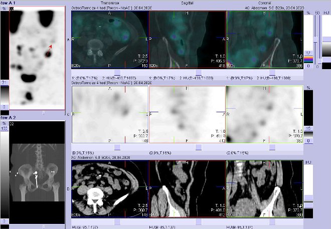 Obr. . 5: Fze SPECT/CT bicha a pnve 4 hod. po aplikaci OctreoScanu. Zameno na loisko v bie vlevo nad pnv.
